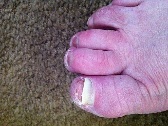 toe.jpg